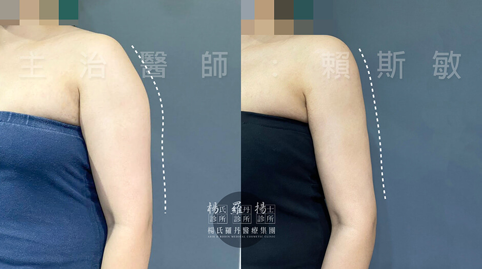 手臂 減脂手術 瘦手臂 抽脂心得